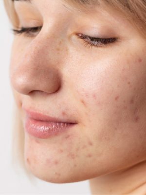 Acne huid