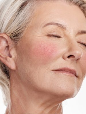 Rosacea