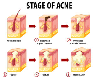 The Different Stages of Acne in the Skin
